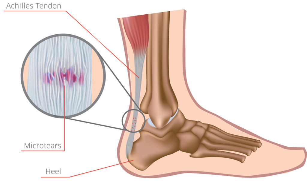 Achilles Tendinopathy; What is it? What 