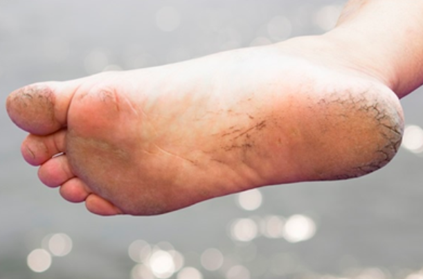 Cracked Heels: Callous Management and Complications | Podiatry First