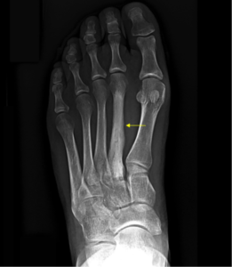 What is a hairline fracture? - Podiatry First